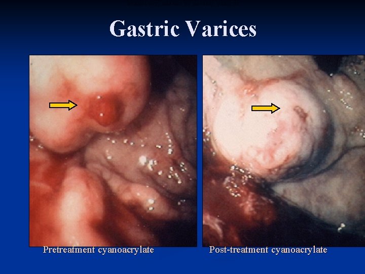 ENDOSCOPIC IMAGES OF GASTRIC VARICES Gastric Varices Pretreatment cyanoacrylate Post-treatment cyanoacrylate 