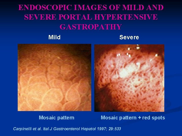 Mild and Severe Portal Hypertensive Gastropathy ENDOSCOPIC IMAGES OF MILD AND SEVERE PORTAL HYPERTENSIVE