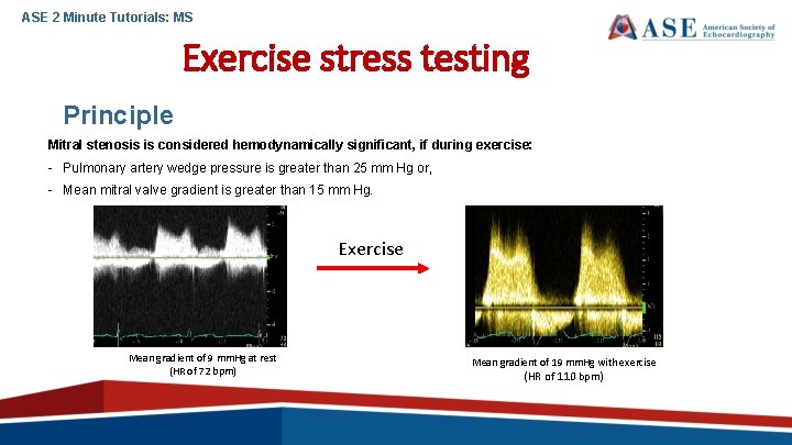 ASE 2 Minute Tutorials: MS Exercise stress testing Principle Mitral stenosis is considered hemodynamically