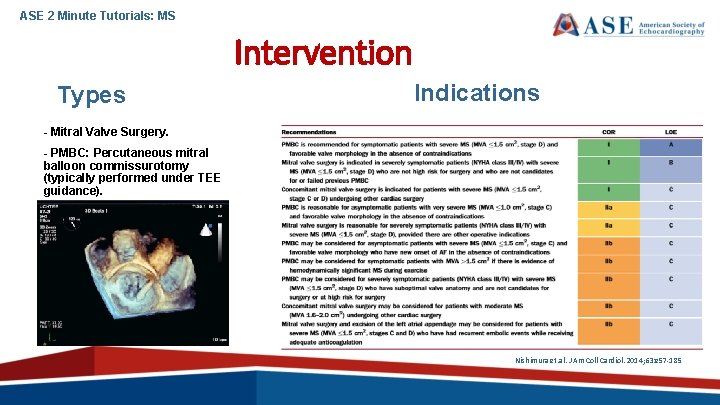 ASE 2 Minute Tutorials: MS Intervention Types Indications - Mitral Valve Surgery. - PMBC: