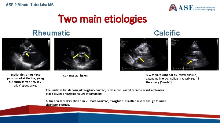 ASE 2 Minute Tutorials: MS Two main etiologies Rheumatic Leaflet thickening most pronounced at