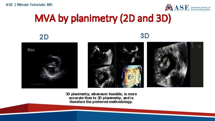 ASE 2 Minute Tutorials: MS MVA by planimetry (2 D and 3 D) 3