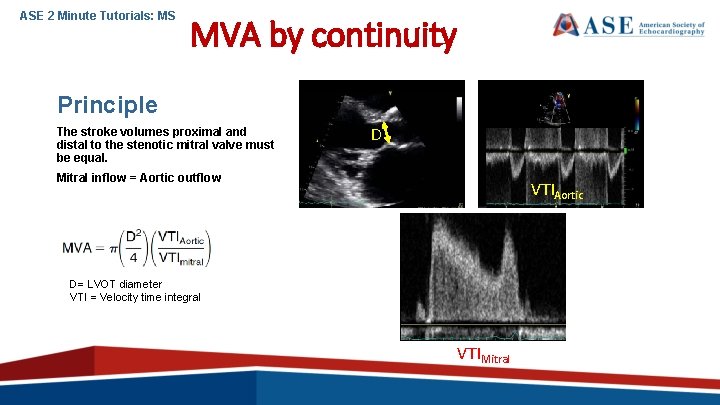 ASE 2 Minute Tutorials: MS MVA by continuity Principle The stroke volumes proximal and