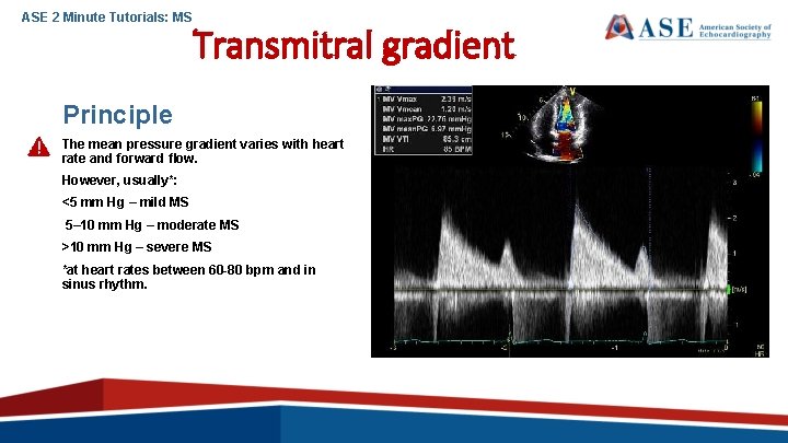 ASE 2 Minute Tutorials: MS Transmitral gradient Principle The mean pressure gradient varies with