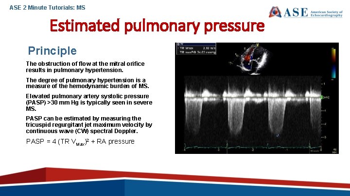 ASE 2 Minute Tutorials: MS Estimated pulmonary pressure Principle The obstruction of flow at