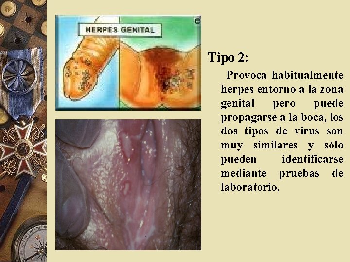 Tipo 2: Provoca habitualmente herpes entorno a la zona genital pero puede propagarse a