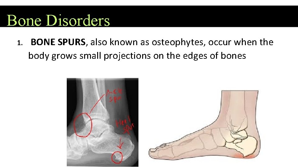 Bone Disorders 1. BONE SPURS, also known as osteophytes, occur when the body grows