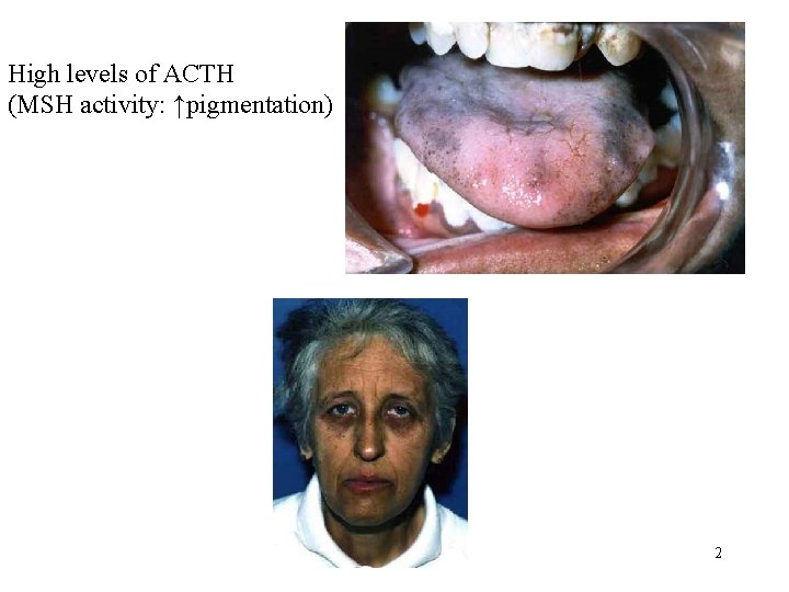 High levels of ACTH (MSH activity: ↑pigmentation) 2 