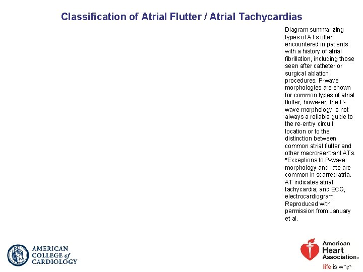 Classification of Atrial Flutter / Atrial Tachycardias Diagram summarizing types of ATs often encountered
