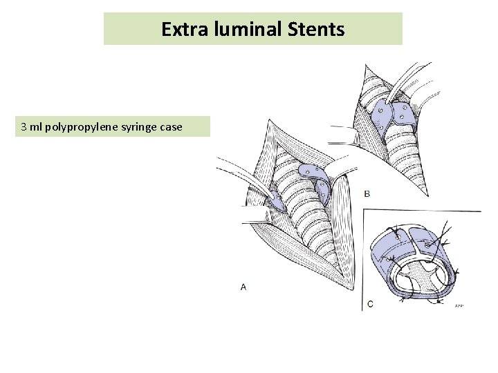 Extra luminal Stents 3 ml polypropylene syringe case 