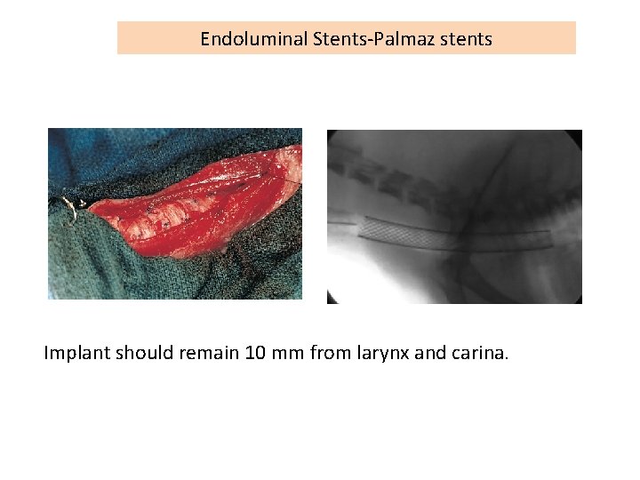 Endoluminal Stents-Palmaz stents Implant should remain 10 mm from larynx and carina. 