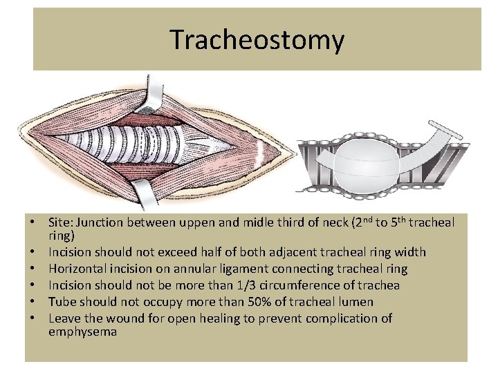 Tracheostomy • Site: Junction between uppen and midle third of neck (2 nd to