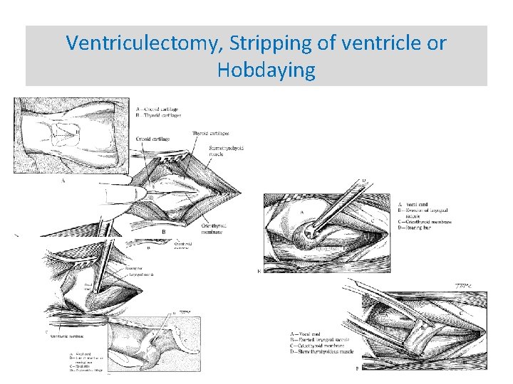 Ventriculectomy, Stripping of ventricle or Hobdaying 