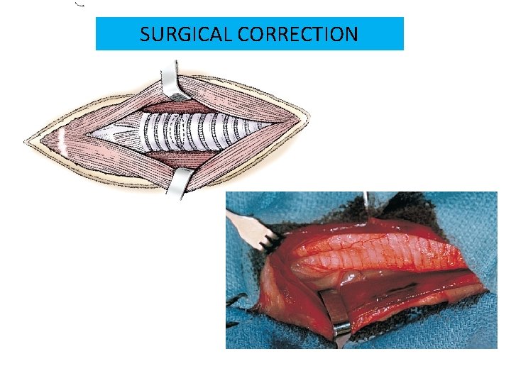 SURGICAL CORRECTION 