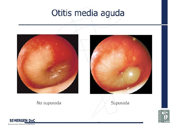 Otitis media aguda 