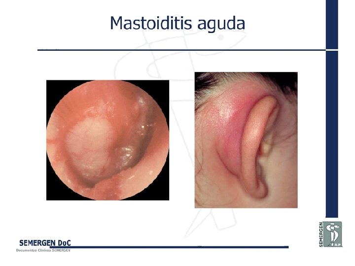 Mastoiditis aguda 