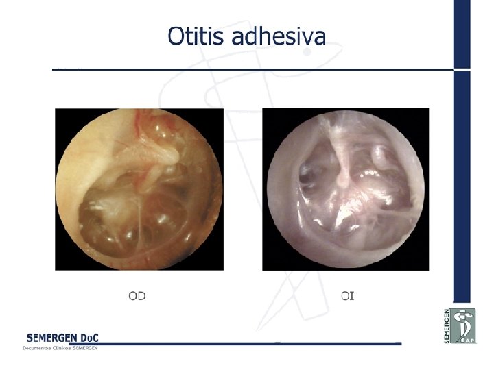 Otitis adhesiva 