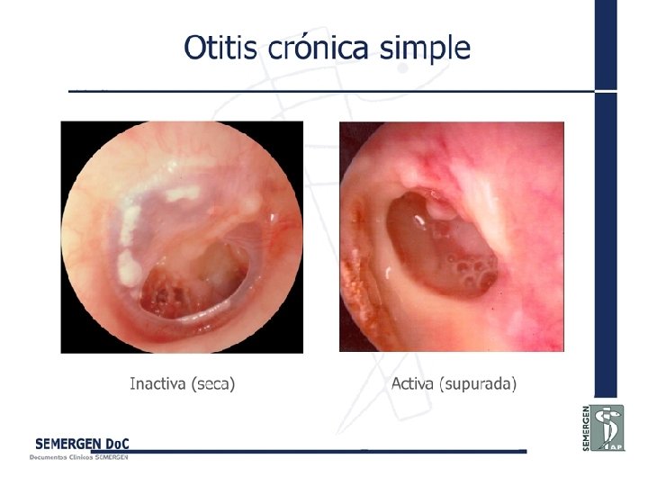 Otitis crónica simple 