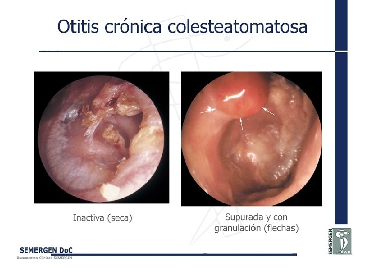 Otitis crónica colesteatomatosa 