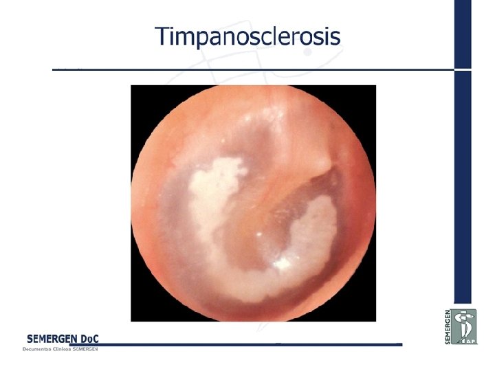 Timpanosclerosis 