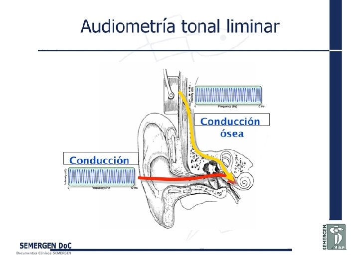 Audiometría tonal liminar 