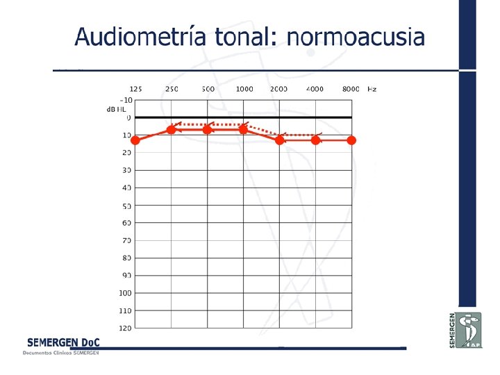 Audiometría tonal: normoacusia 