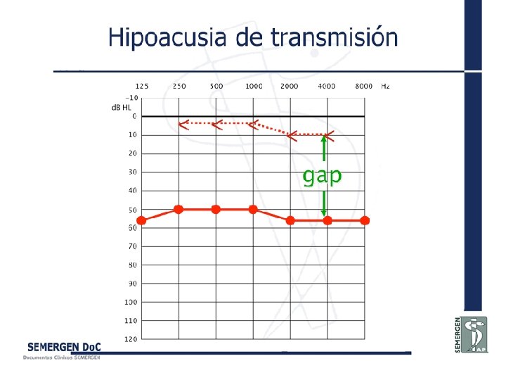 Hipoacusia de transmisión 