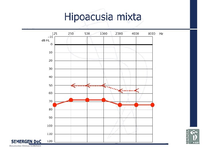 Hipoacusia mixta 