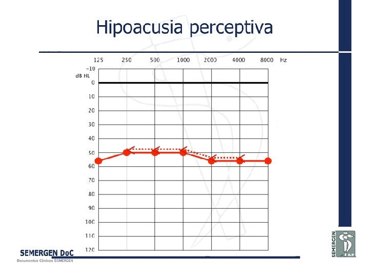 Hipoacusia perceptiva 