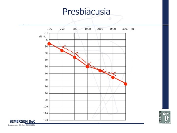 Presbiacusia 