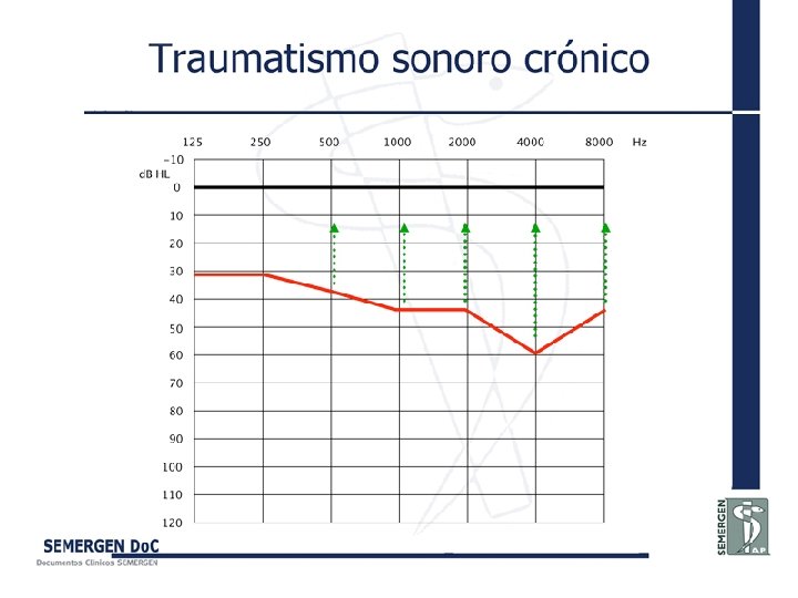 Traumatismo sonoro crónico 