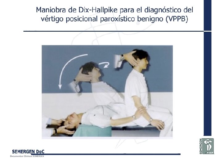 Maniobra de Dix-Hallpike para el diagnóstico del vértigo posicional paroxístico benigno (VPPB) 