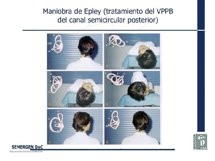 Maniobra de Epley (tratamiento del VPPB del canal semicircular posterior) 