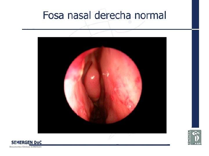 Fosa nasal derecha normal 