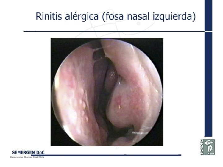 Rinitis alérgica (fosa nasal izquierda) 