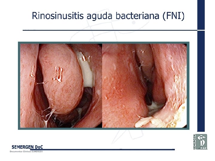 Rinosinusitis aguda bacteriana (FNI) 