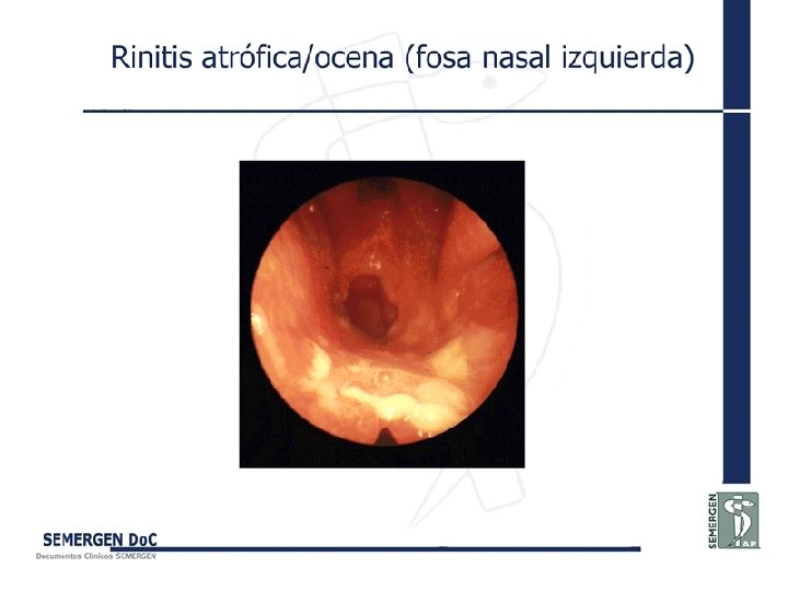 Rinitis atrófica/ocena (fosa nasal izquierda) 