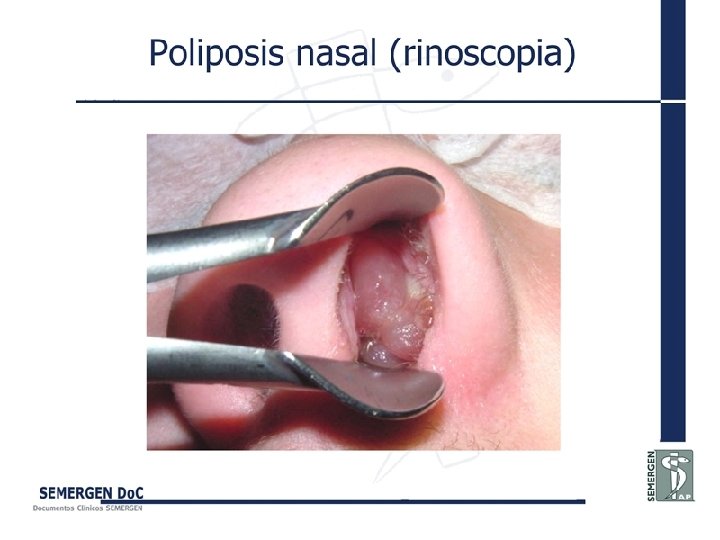 Poliposis nasal (rinoscopia) 