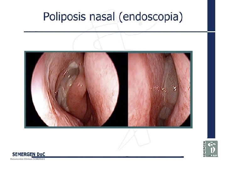 Poliposis nasal (endoscopia) 