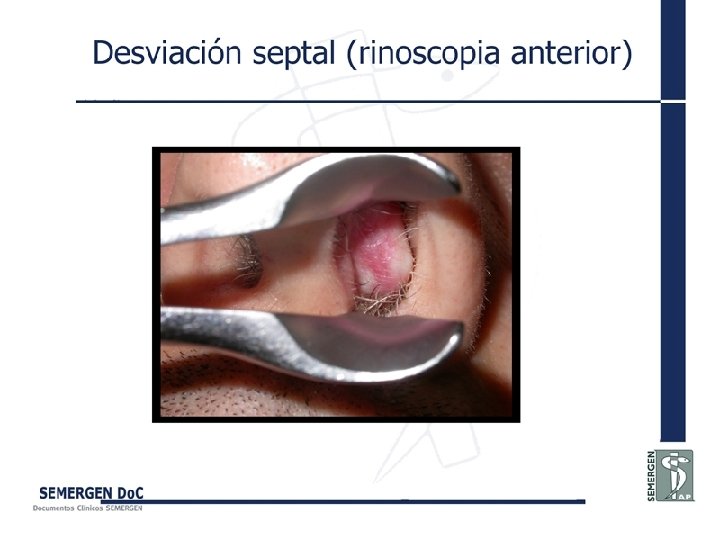 Desviación septal (rinoscopia anterior) 