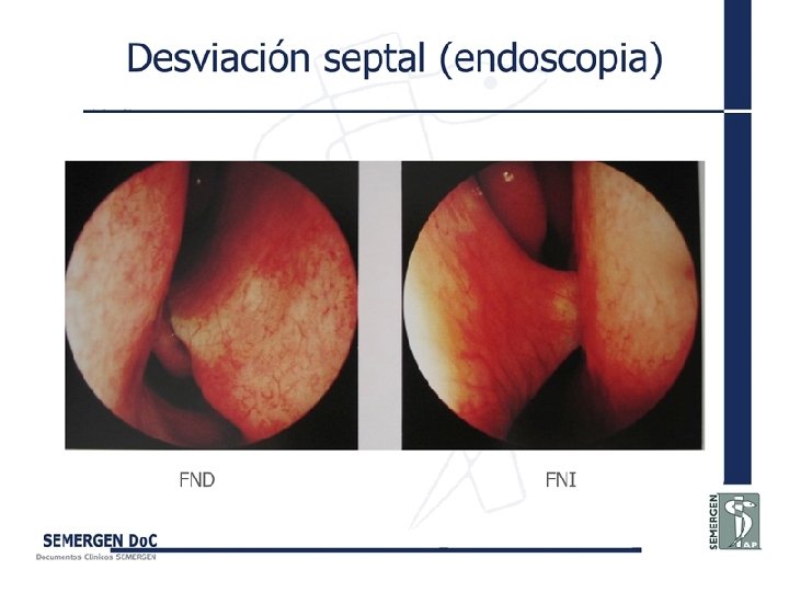 Desviación septal (endoscopia) 