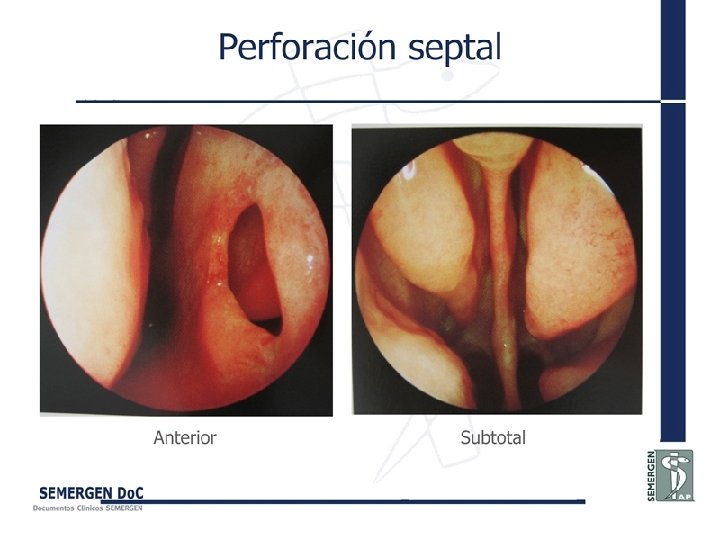 Perforación septal 