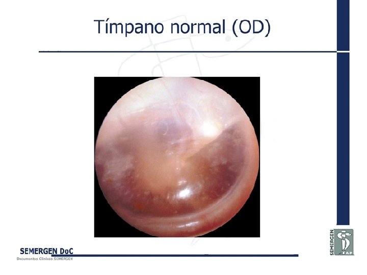 Tímpano normal (OD) 