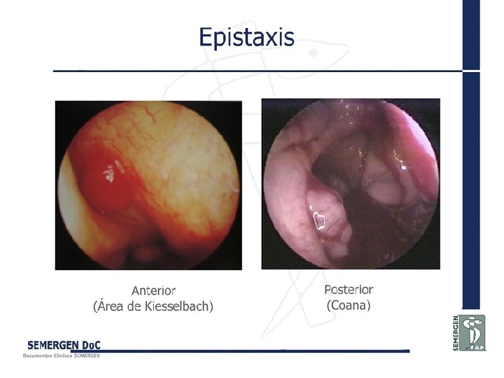 Epistaxis 