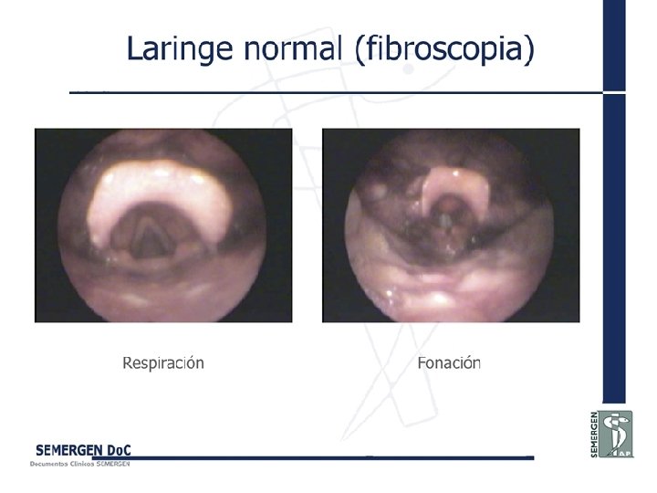 Laringe normal (fibroscopia) 