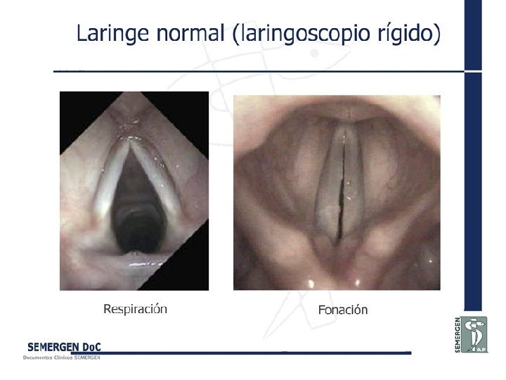 Laringe normal (laringoscopio rígido) 