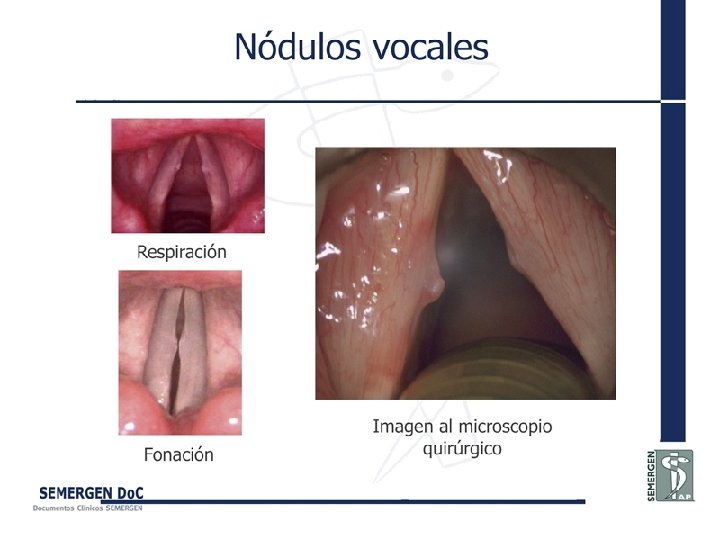 Nódulos vocales 