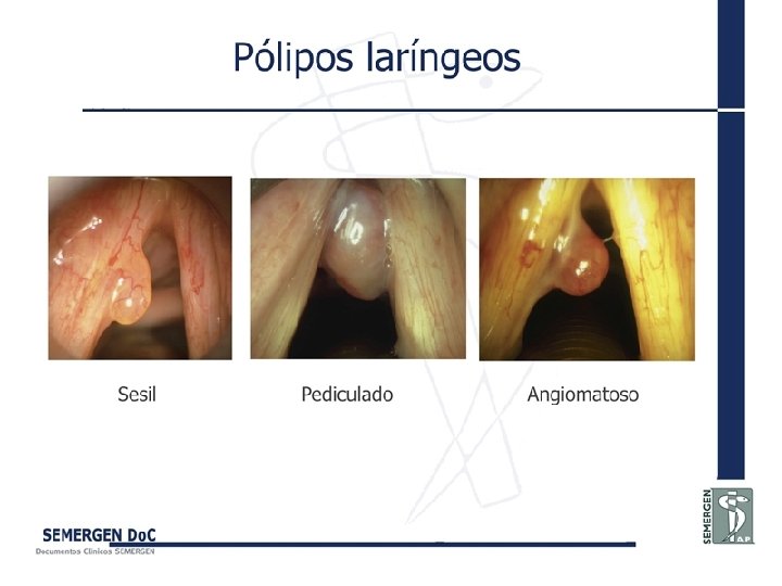 Pólipos laríngeos 