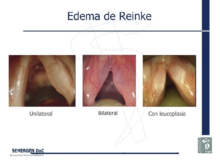 Edema de Reinke 