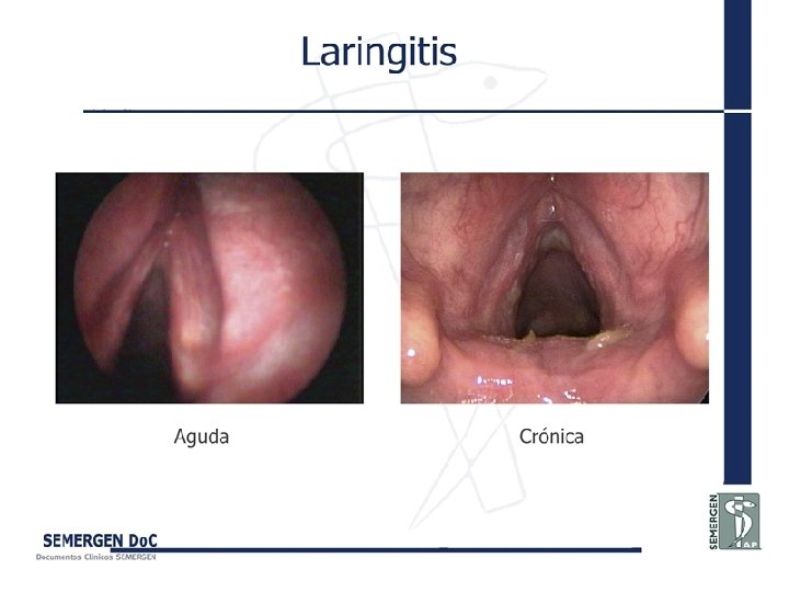 Laringitis 